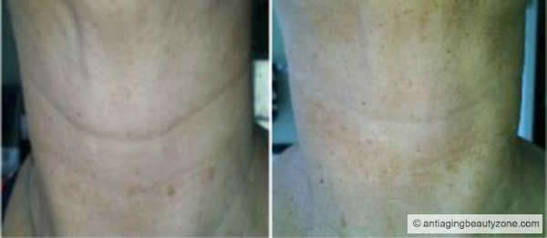 Before and after neck photo showing some improvement in deeper lines after using topical vitamin C