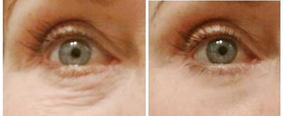 My remedies for under eye wrinkles