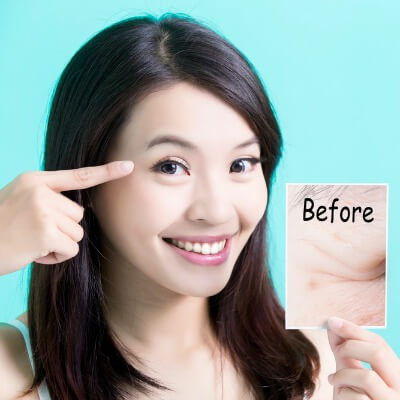 Tips for Treating Crow's Feet Without Fillers.