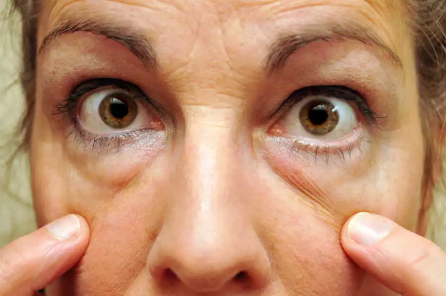 Woman showing lower cheek puffiness from malar bags or festoons